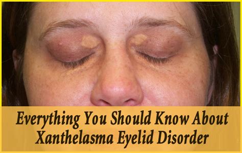 Everything You Should Know About Xanthelasma Eyelid Disorder