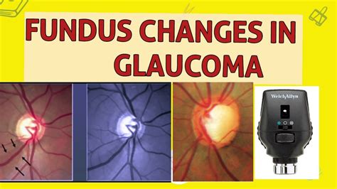 Optic Disc Changes In Glaucoma Youtube