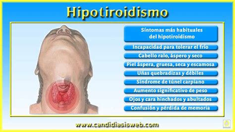 sÃ ntomas de tiroides inflamada Petrus Maximinus