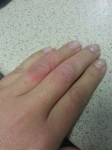 I Have A Red Dry Irratable Rash On Two Fingers On My Left