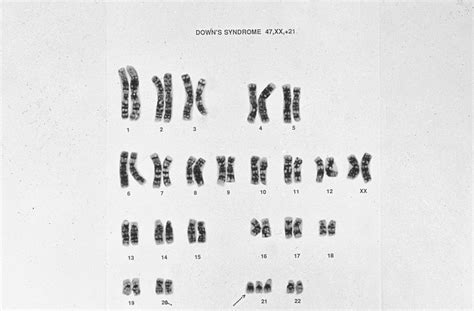 Downs Syndrome Karyotype 47xx21 Wellcome Collection