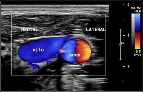 Ultrassonografia Vascular Com Doppler Modo B Cervical à Esquerda