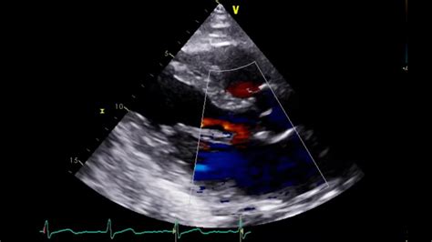 Flail Motion Of The Posterior Mitral Leaflet And Severe Mitral