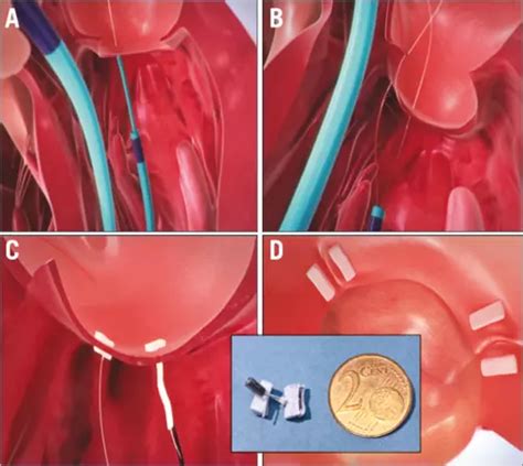 Transcatheter Direct Mitral Valve Annuloplasty A Brief Review