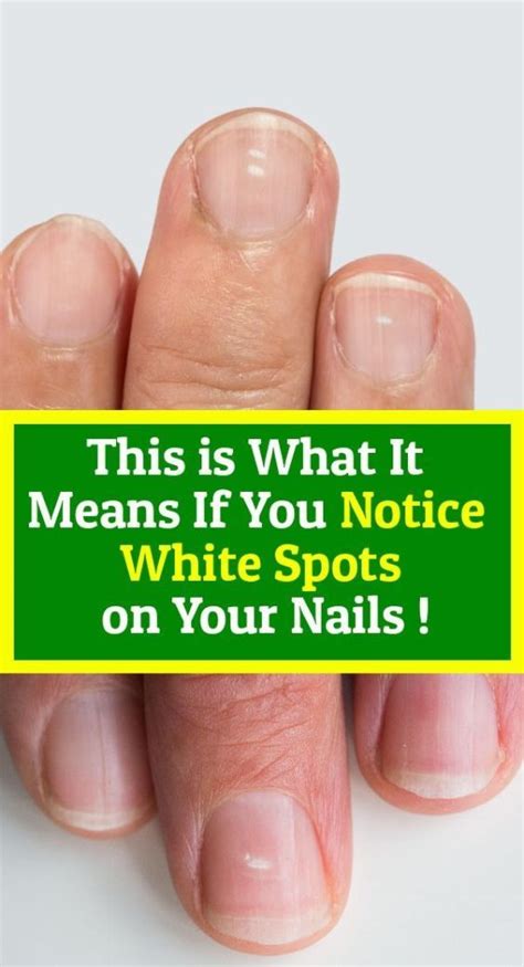 This Is What It Means If You Notice White Spots On Your Nails In 2020