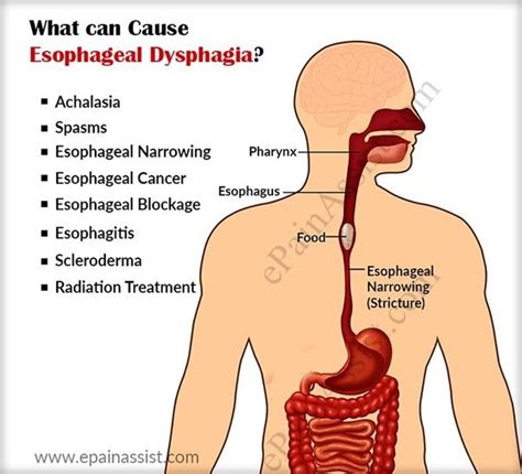Is Esophagus Cancer Aggressive Quora