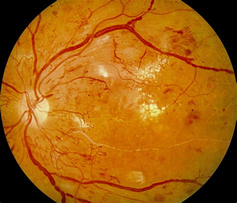 Panretinal Photocoagulation Significantly Reduces Macular Pigment