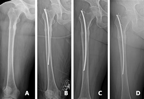 A Novel Surgical Method For Treating Symptomatic Incomplete Atypical