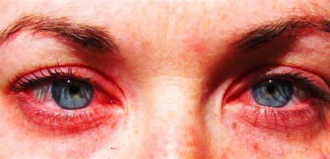 Best Ways To Treat Eye Allergies Chadderton Opticians