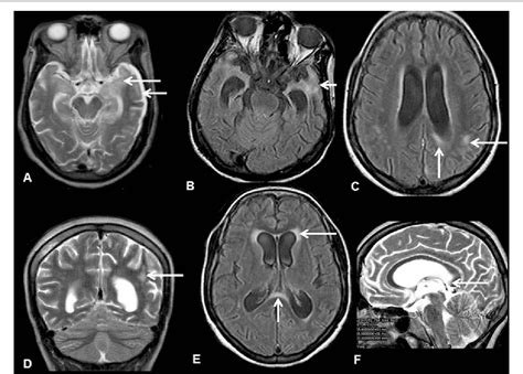Neurosyphilis Mri Features And Their Phenotypic Correlation In A