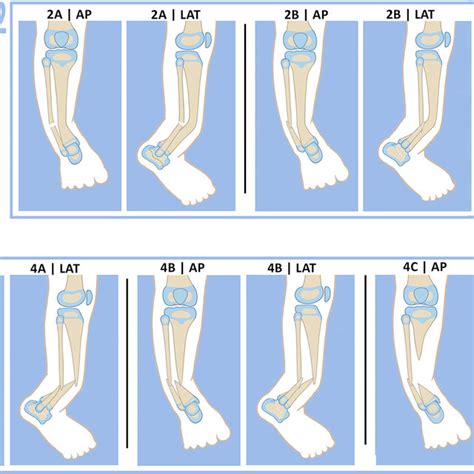 Paley Classification Of Congenital Pseudarthrosis Of The Tibia Type 1