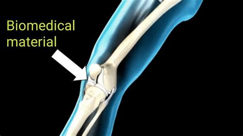 Introduction To Biomedical Materials Youtube