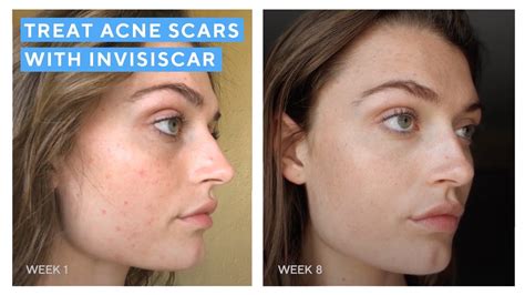The 101 On Invisiscar Resurfacing Treatment Reduce Acne Scars Murad
