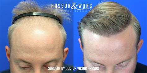 FUE Hair Transplant Before After 4210 FUE Grafts Incredible Results