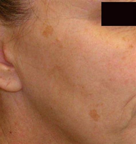 Brown Spots On Skin Pictures Causes Home Remedies Treatment