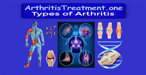 Most Common Types Of Arthritis
