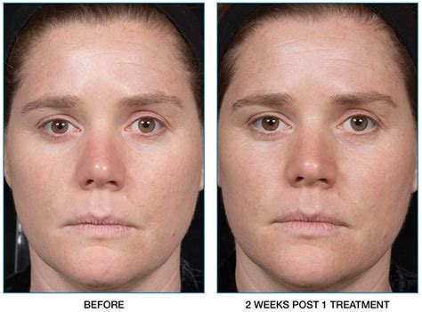 Clear Brilliant Laser Resurfacing Clear And Brilliant Before And