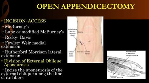 open appendicectomy operative surgery