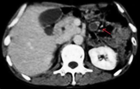Abdominal Computed Tomography Ct Enhanced Ct Shows A Tumor With