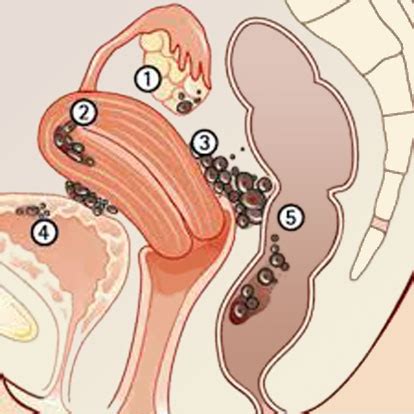 A endometriose é caracterizada pelo crescimento de tecido endometrial fora do útero, em locais como os intestinos, ovários, trompas de falópio ou bexiga. Endométriose