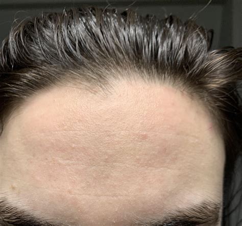 Skin Concerns Anybody Know How I Could Improve My Forehead Texture
