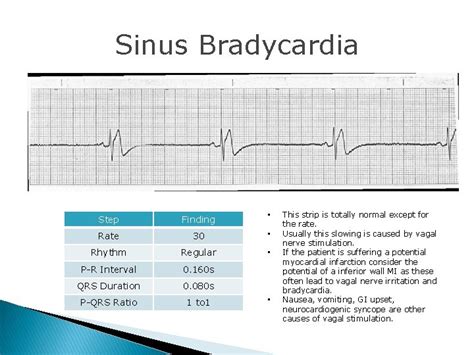 画像をダウンロード Sinus Bradycardia Rhythm 6 Second Strip 231918