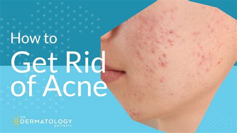 Best Dermatologist In San Diego For Acne Products And Services