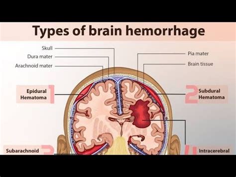 Subarachnoid Hemorrhage Explained By Dr P N Renjen Youtube