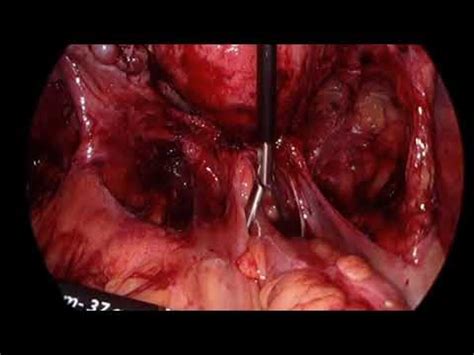 Just a few endometrial implants located outside the uterus and a small number of mild adhesions. unedited TLH stage 4 endometriosis using the lateral to ...