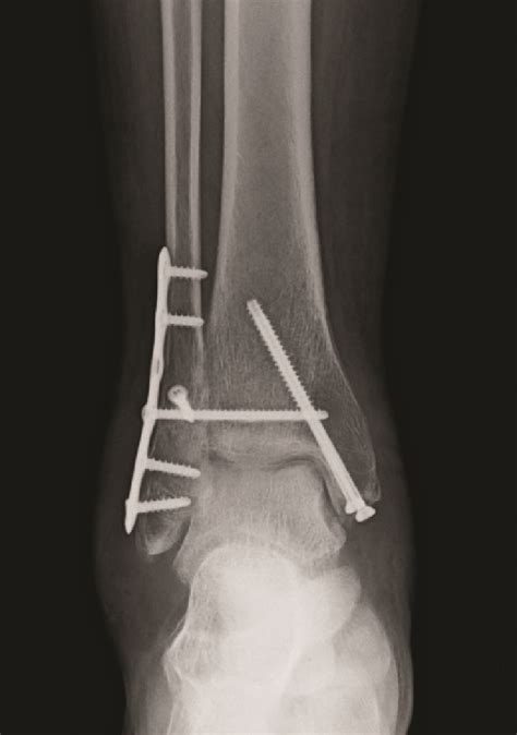 What you need to know: Current Insights On Fixation Options For Ankle Syndesmosis ...