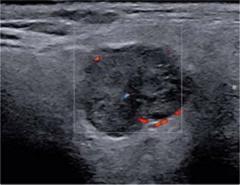 A Hypoechoic Lobulated Circumscribed Lesion With Posterior Acoustic