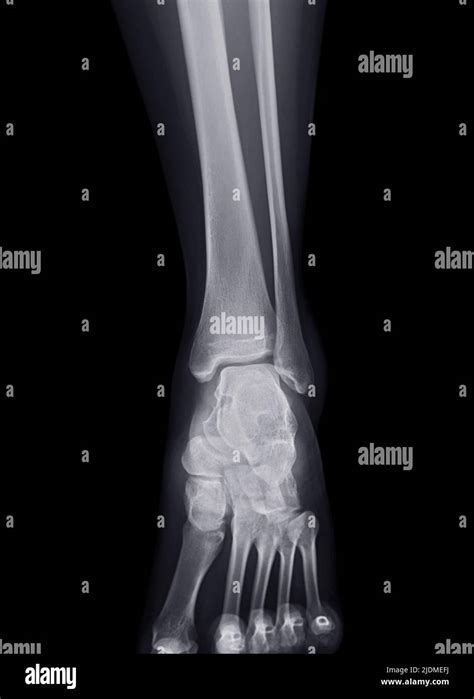 X Ray Image Of Ankle Joint For Diagnosis Fracture Tibia And Fibula Bone