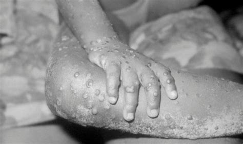 Fever, headache, muscle aches, swollen lymph nodes, chills, and exhaustion. Monkeypox UK warning: How do you catch monkeypox? Signs ...