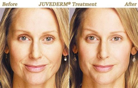 Photos Botox Juvederm Photofacial Chemical Peel