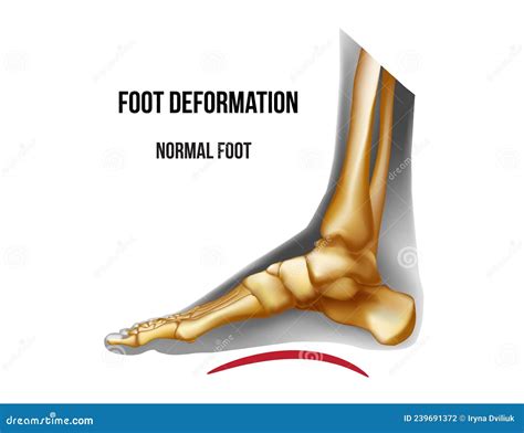 Foot With Normal Heel And Foot With Haglunds Deformity And Bursitis