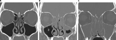 Phenotypic Heterogeneity Of Crs On The Basis Of Polyposis Computed