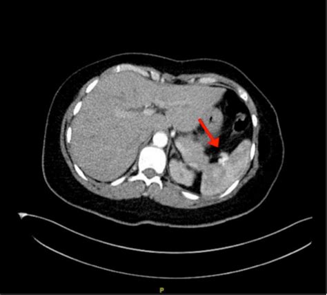 Cureus Multiple Incidental Unruptured Splenic Artery Aneurysms