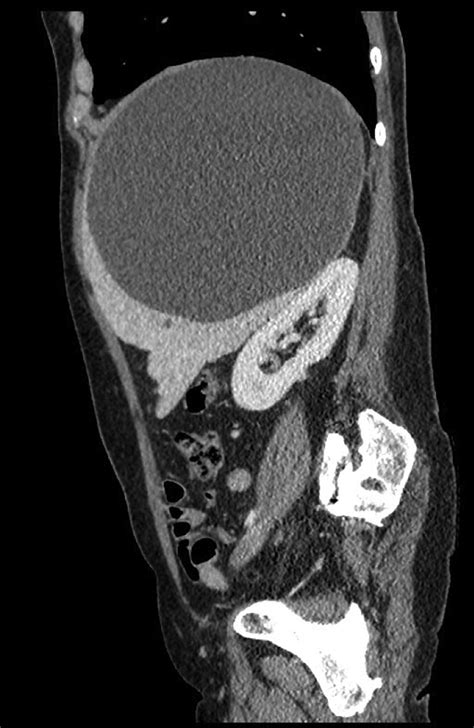 Contrast Enhanced Ct Scan Sagittal Projection On The Day Of Hospital