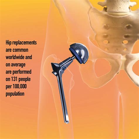 Hip Replacement Fundamentals The Putney Clinic Of Physical Therapy