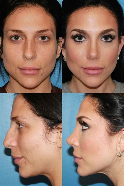 Rhinoplasty Before And After Photos Sandiego Nosejob Rhinoplasty Before And After Nose