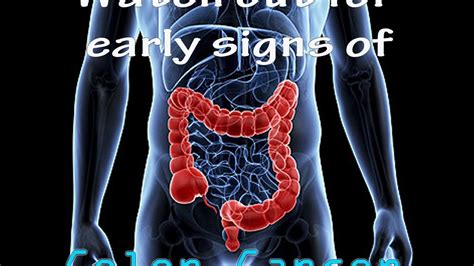 Watch Out For Early Signs Of Colon Cancer Watch Now Youtube