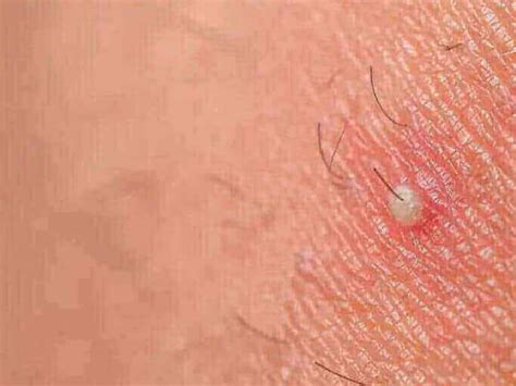 Ingrown Hair Causes Symptoms How To Remove And Prevent Nubo Beauty