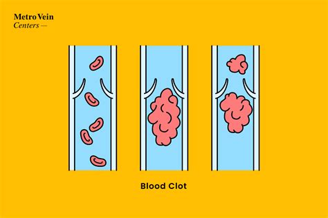 How To Prevent Blood Clots Metro Vein Centers