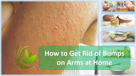 How To Get Rid Of White Bumps On Arms With Images Bumps On Arms