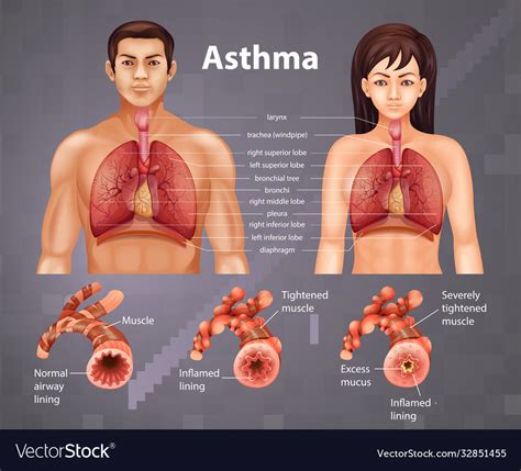 Comparison Healthy Lung And Asthmatic Lung Vector Image