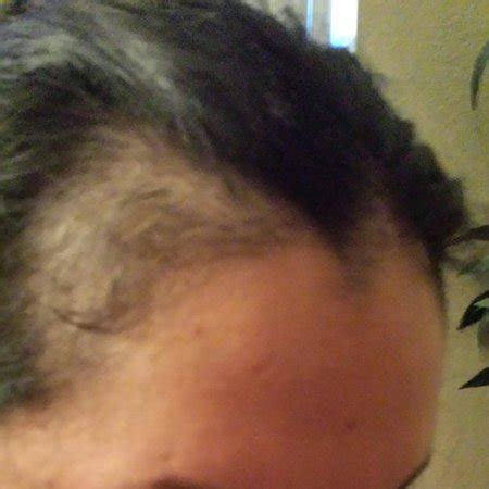 If you have experienced postpartum hair loss a few months after birth, you have probably seen bald patches. Post partum hair loss - is this normal *pic* - Page 4 ...