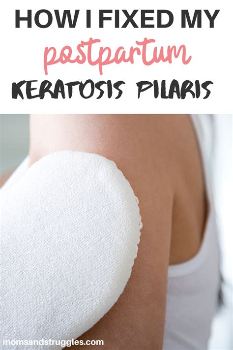 Essential Oils For Keratosis Pilaris How To Properly Use Essential
