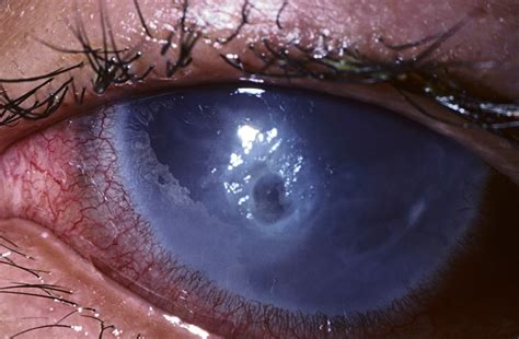 What Is A Predisposing Factor For This Type Of Corneal Ulcer Caused By My Xxx Hot Girl