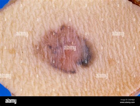 Skin Cancer Gross Specimen Of A Malignant Melanoma Dark Area A Type