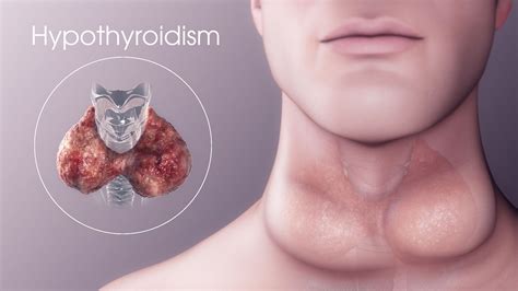 Hypothyroidism Causes Pathophysiology Management And Treatment